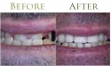 Dental teeth whitening before and after