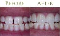 Dental tooth whitening before and after