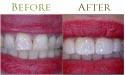 Dental teeth whitening before and after