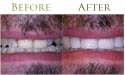Dental tooth whitening before and after