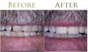 oral teeth whitening before and after
